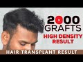 Fue hair transplant results  qht fue hair transplant results