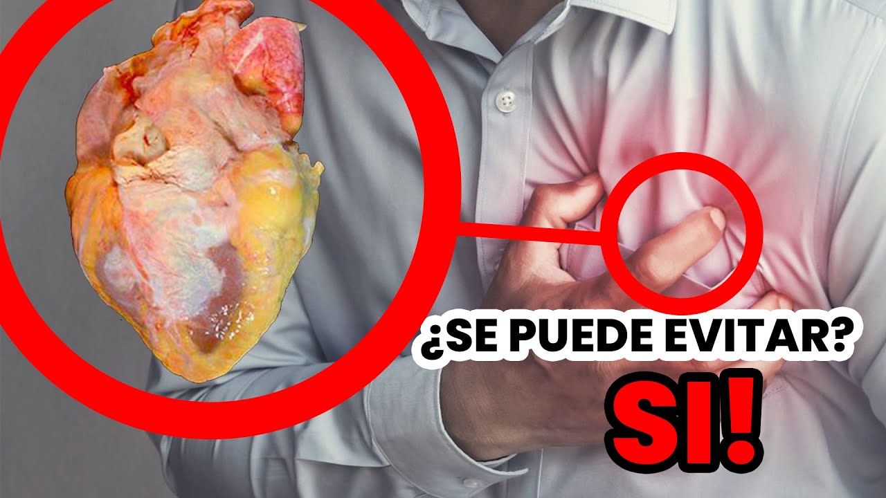 SINTOMAS DEL INFARTO UN MES ANTES DE SU APARICIÓN. RECONÓCELOS - YouTube