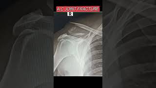 A.C Joint Fracture | Clavicle Fracture