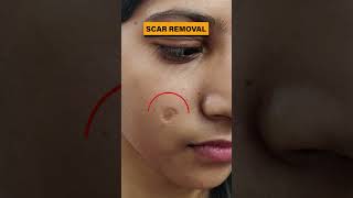 Scar Removal Treatment in Delhi | Scar removal results before and after scar scarremoval scars