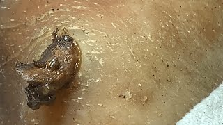 Download Lagu 𝑪𝒚𝒔𝒕𝒊𝒄 𝑨𝒄𝒏𝒆 𝑹𝒆𝒎𝒐𝒗𝒂𝒍 \u0026 𝑰𝒏𝒇𝒍𝒂𝒎𝒎𝒂𝒕𝒐𝒓𝒚 𝑨𝒄𝒏𝒆 𝒇𝒐𝒓 𝑰𝒏𝒏𝒆𝒓 𝑷𝒆𝒂𝒄𝒆 #0965 MP3