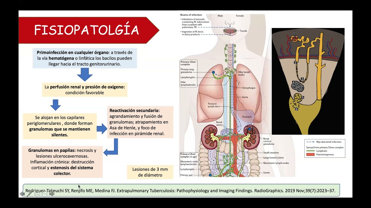 Tuberculosis renal – SOCIEM UCV PIURA - YouTube
