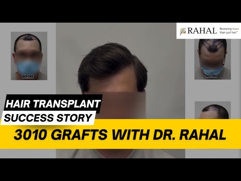 Hair Transplant Results 3010 Grafts With Dr Rahal