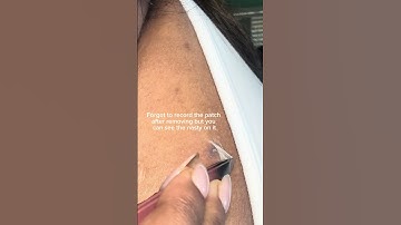 Pimple Patch Removal!😖