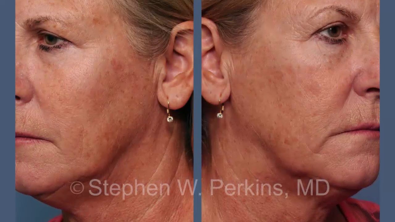 Skin Resurfacing by Dr. Stephen W. Perkins