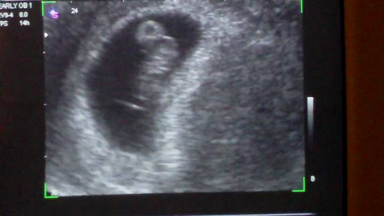 First ultrasound - 7 weeks, 6 days - YouTube