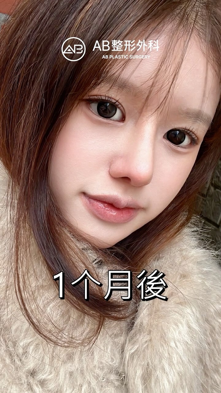 眼整形＋隆鼻後，整體氣質完全不一樣了 #Shorts