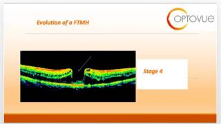 OCT Interpretation Session 3 Variations of Macular Holes