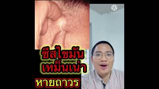 ซีสไขมัน เหม็นเน่า หายขาด หายทั้งตัว