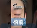 【二重切開&目頭切開】メンズの目整形‼️キズアト公開☆