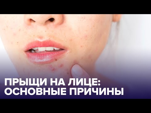 ПРЫЩИ на лице: почему они появляются?