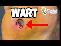 THE MOTHER WART | WART REMOVAL OF AN ENORMOUS PLANTAR WART!