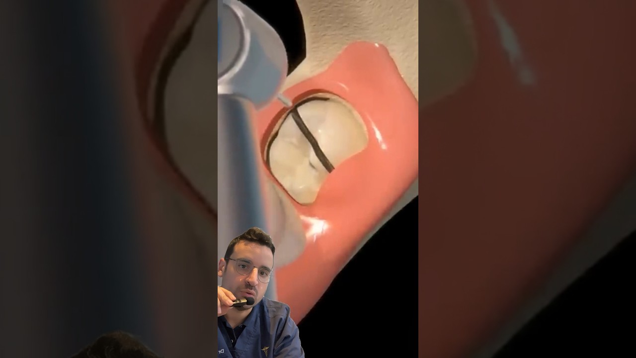 EXTRACTION, dent de SAGESSE incluse