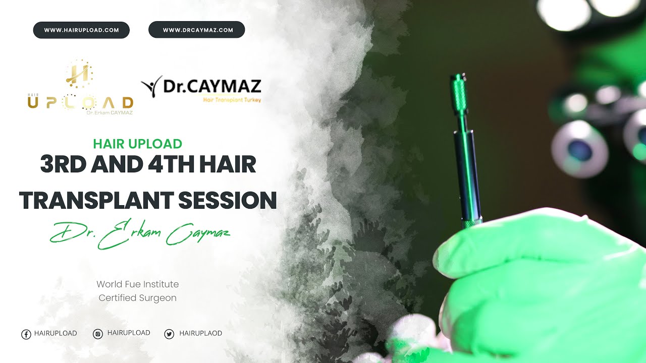 3rd and 4th Hair Transplant Session mp4