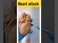 Heart ❤️ attack | cardiac arrest #medical #mbbs #biology #neet #science #health