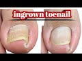 Ingrown toenail removal  igtn surgery  doctor 2024