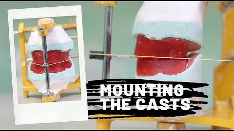 Mounting the casts on a mean value articulator | DEMO