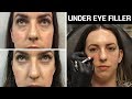 All About Under Eye Filler 💉 Restylane & Restylane Lyft, Before & After Photos, Does It Work, Cost