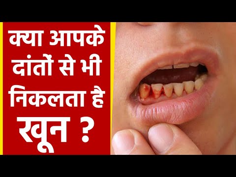 दांतों से खून आना | दांतों से खून क्यों आता है | दांतों से खून आने का इलाज | Boldsky