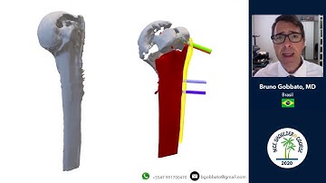 Personalized 3D Molding Technique for the Treatment of Proximal Humerus Fractures Malunion