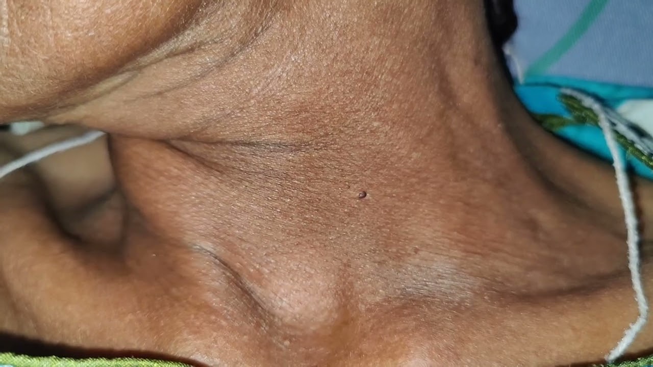 Dancing Carotids or Corrigan's Sign in Aortic Regurgitation