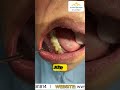Restore Missing Teeth with Natural-Looking Crowns &amp; Bridges | Smile Makeover at The Dental Home