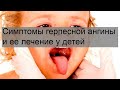 Симптомы герпесной ангины и ее лечение у детей