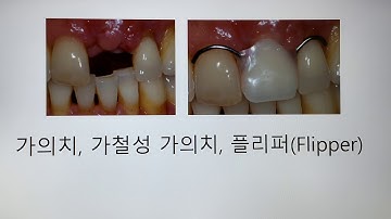 가의치 & 임시덴쳐 (보철용어 풀이)