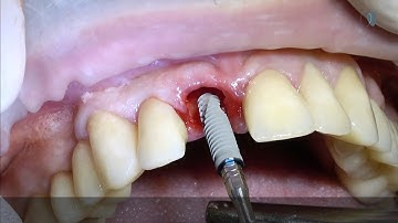 Central incisor implant placement.       Socket shield technique.