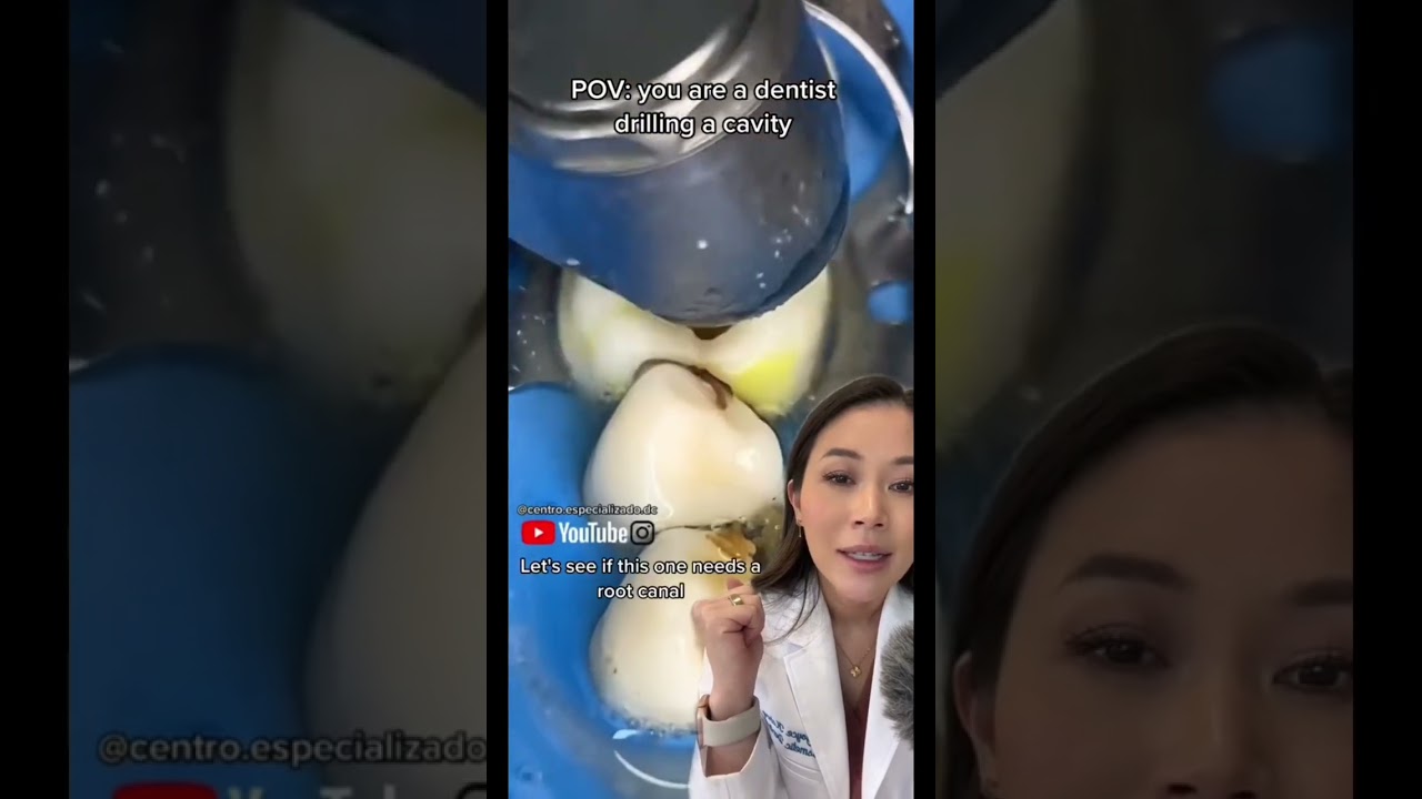 Another gigantic cavity being cleaned and filled. Catch the rest of my TikTok! 