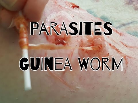 Guinea Worm || Parasites