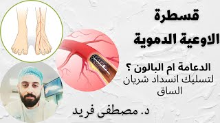 سؤال هام : الدعامة ام البالون ؟ لتسليك انسداد شريان الساق | د. مصطفى فريد