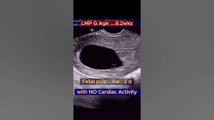 Early Pregnancy Miscarriage (Missed Abortion ) #ultrasound #pregnancy #miscarriage