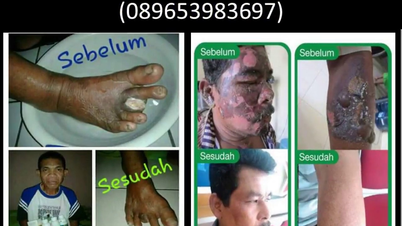 Penyembuhan diabetes basah