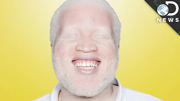 C'est quoi un albinos ?