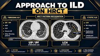 Approach to Interstitial Lung Disease (ILD) on HRCT: Diagnostic Decision Tree