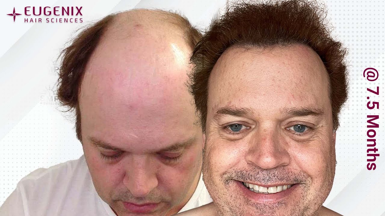 Miraculous Transformation Through Hair Transplant Is Possible Eugenix