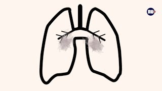Tips Van De Dokter Wat Doet Roken Met Je Longen?