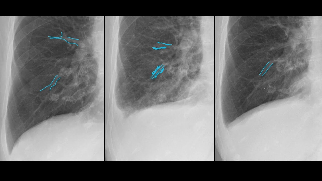 pulmonalvenöse Stauung im Lungenröntgen - Eine Einführung für MedizinstudentInnen