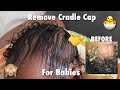 Completely Remove Cradle Cap (Sped Up) | Visual ASMR | No Music