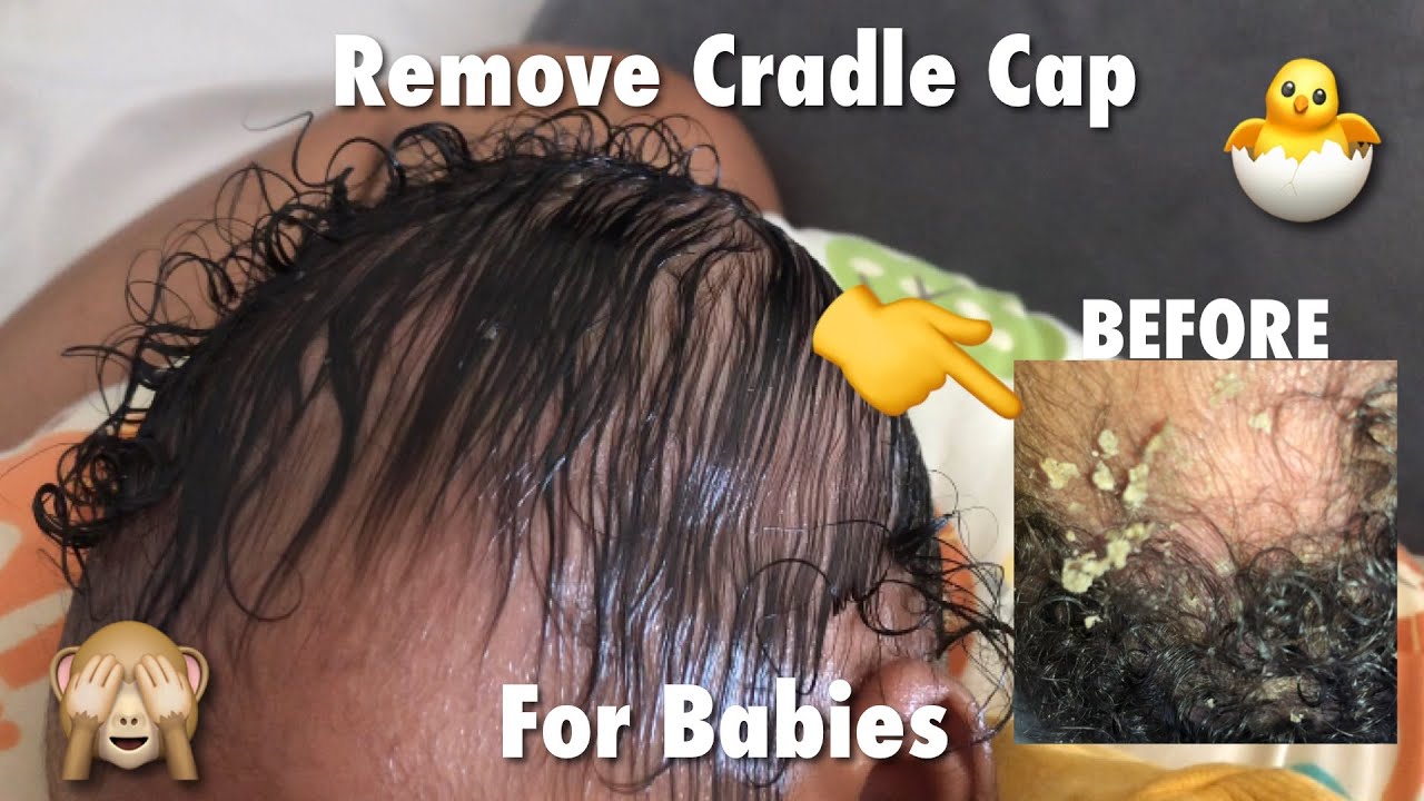 Completely Remove Cradle Cap (Sped Up) Visual ASMR No Music YouTube