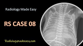 FRCR Radiology RS Cases 08 : A premature baby presented with SOB