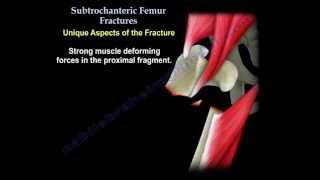 Subtrochanteric Femur Fractures - Everything You Need To Know - Dr. Nabil Ebraheim