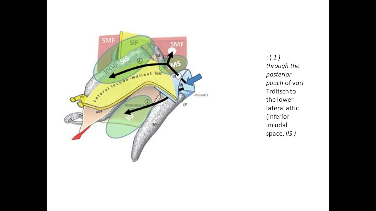 Attic Cholesteatoma growth patterns