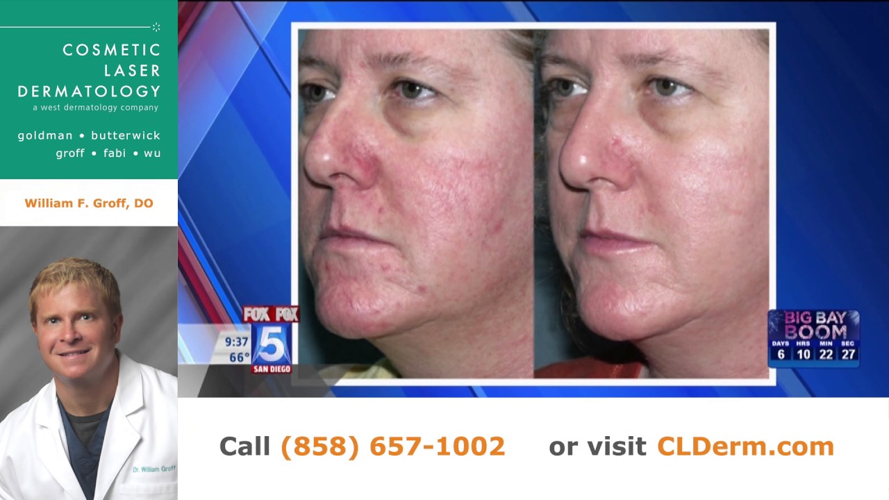 Banner for Treatments for Rosacea