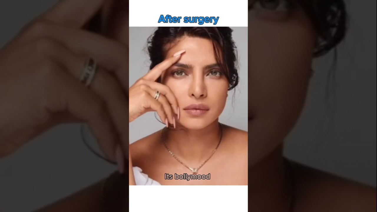 Before & After Surgery – Bollywood Actresses Transformation 💉✨