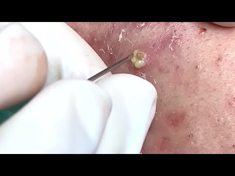 Blackhead Removable # [ cystic acne extraction cystic acne removal ance ]