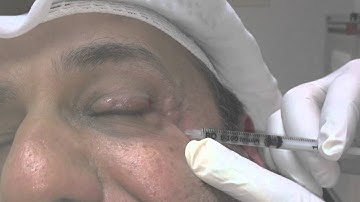 Blepharospasm and Botox Treatment