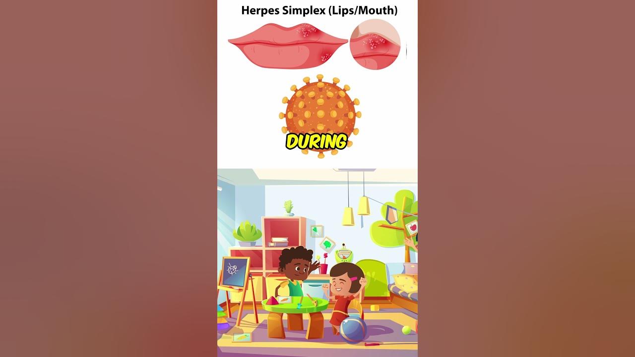 How common is herpes simplex virus hsv1 youtube