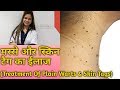 प्लेन Warts और स्किन टेग का ईलाज || Treatment of Plain Warts & Skin Tags Dr Suman Agarwal